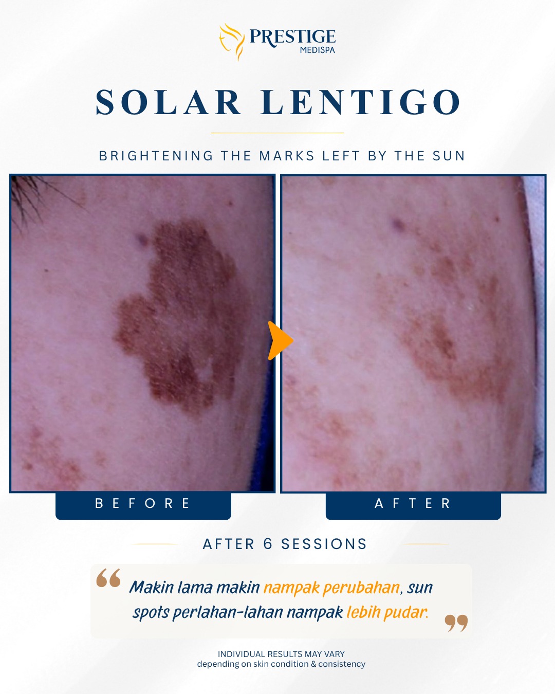 Sebelum dan selepas rawatan solar lentigo