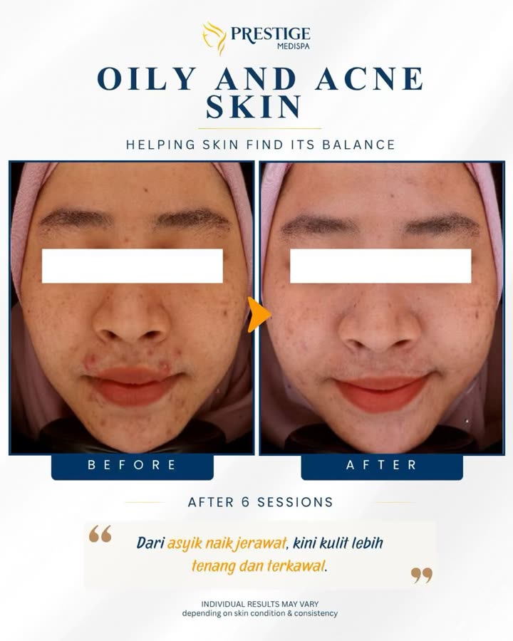 Sebelum dan selepas, kulit berminyak & berjerawat