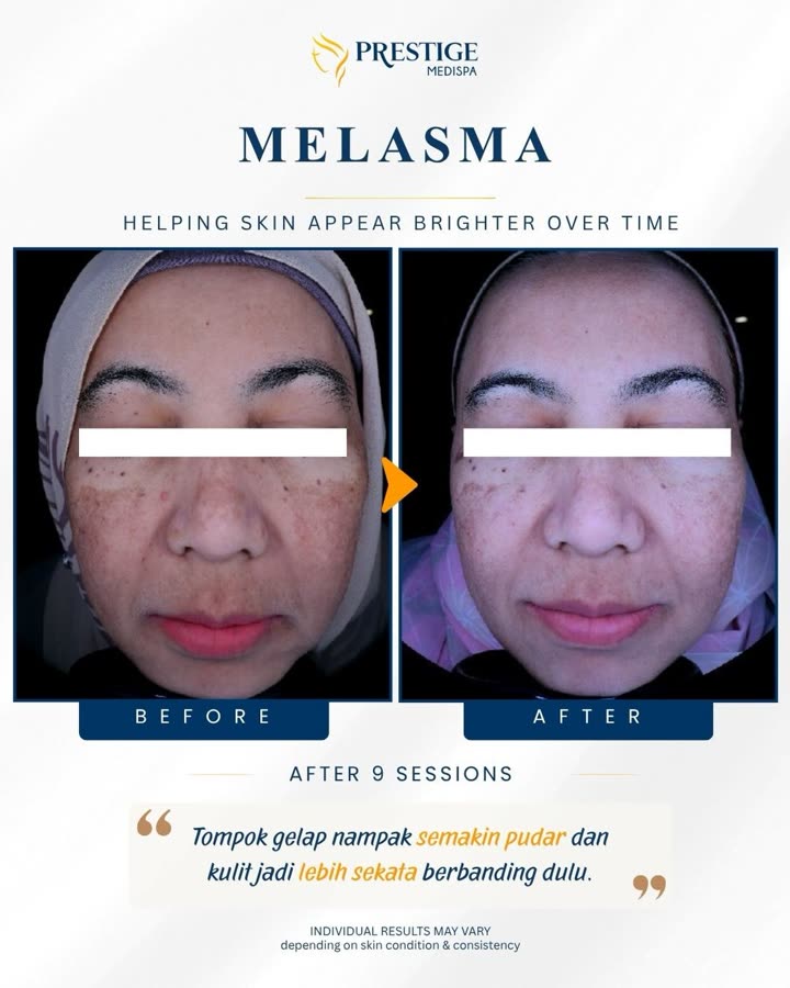 Sebelum dan selepas, melasma