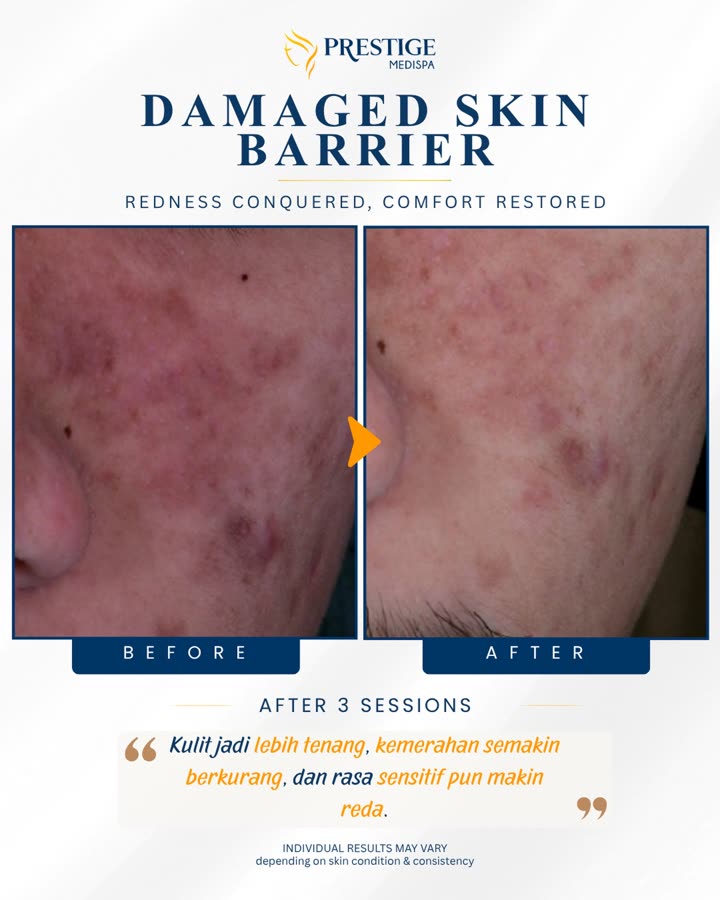 Sebelum dan selepas, skin barrier rosak