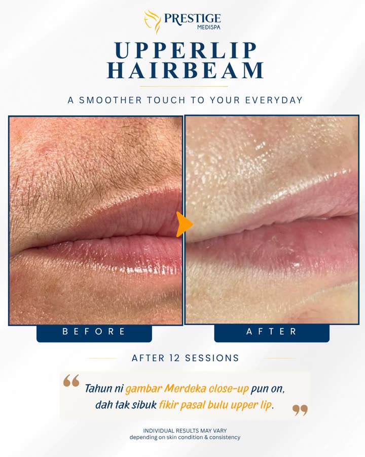 Sebelum dan selepas, bibir atas