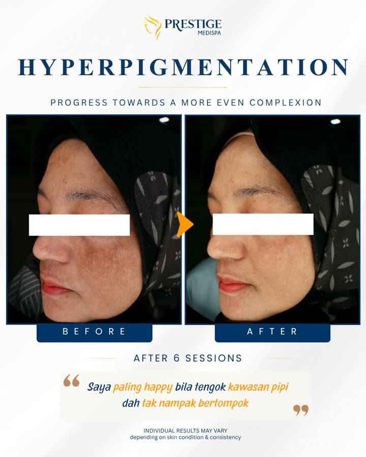 Sebelum dan selepas, hiperpigmentasi