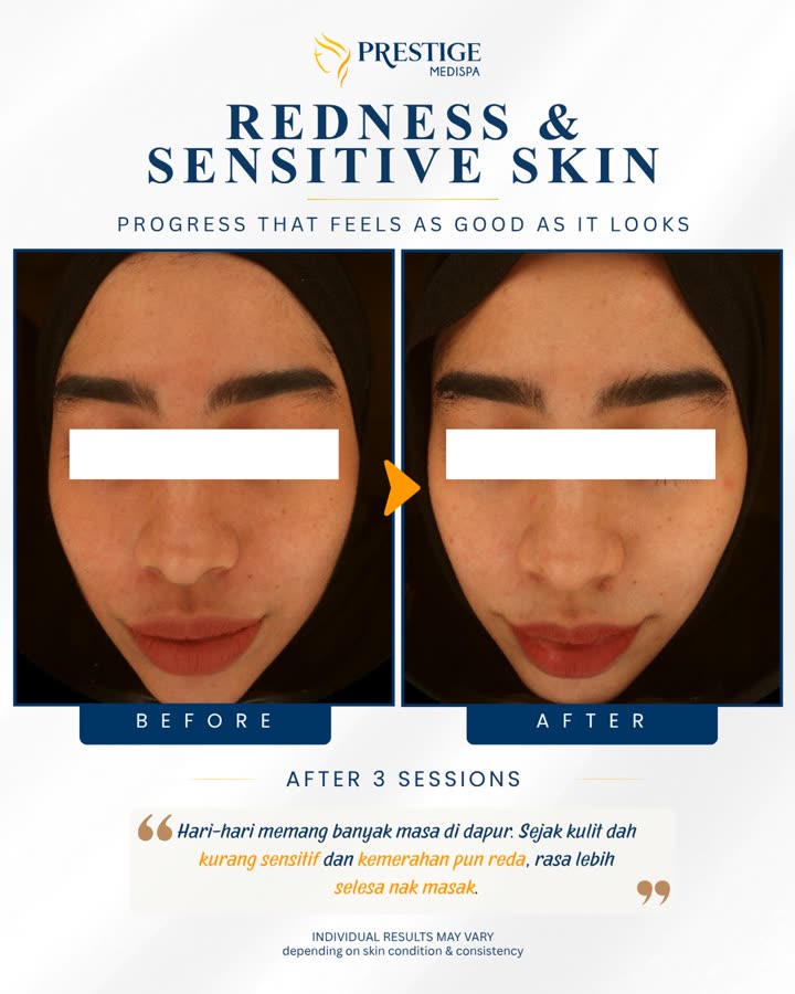 Sebelum dan selepas, kemerahan & kulit sensitif